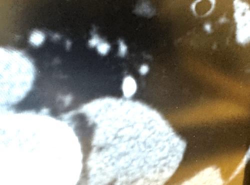 尿路結石の恐怖と対策：激痛の正体からコーヒーの影響まで